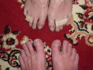 The very painful toes